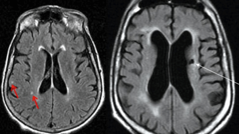 Image of a brain (not mine) showing lesions